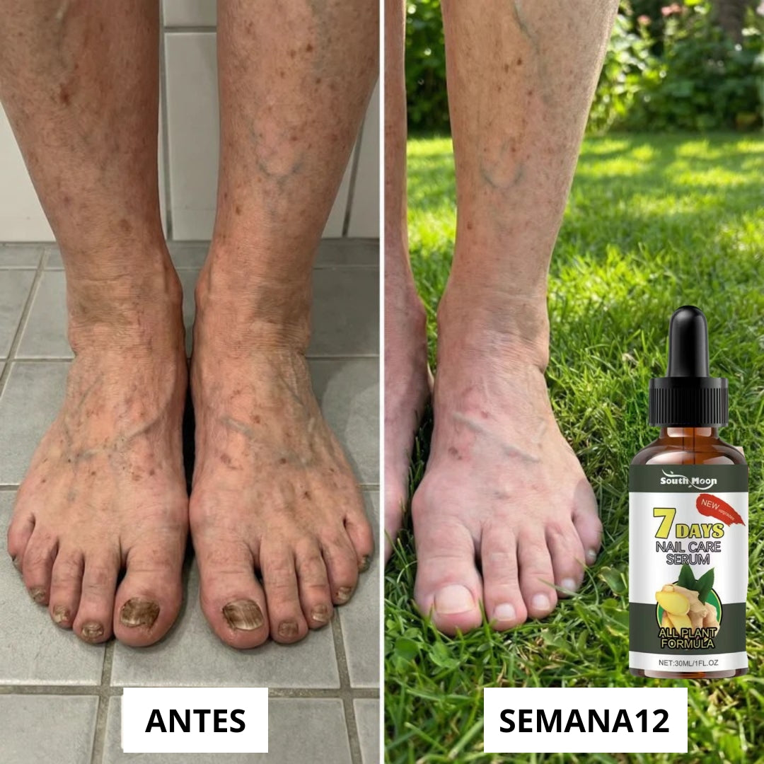 NailCareSerum® | Corta la infección desde la raíz.